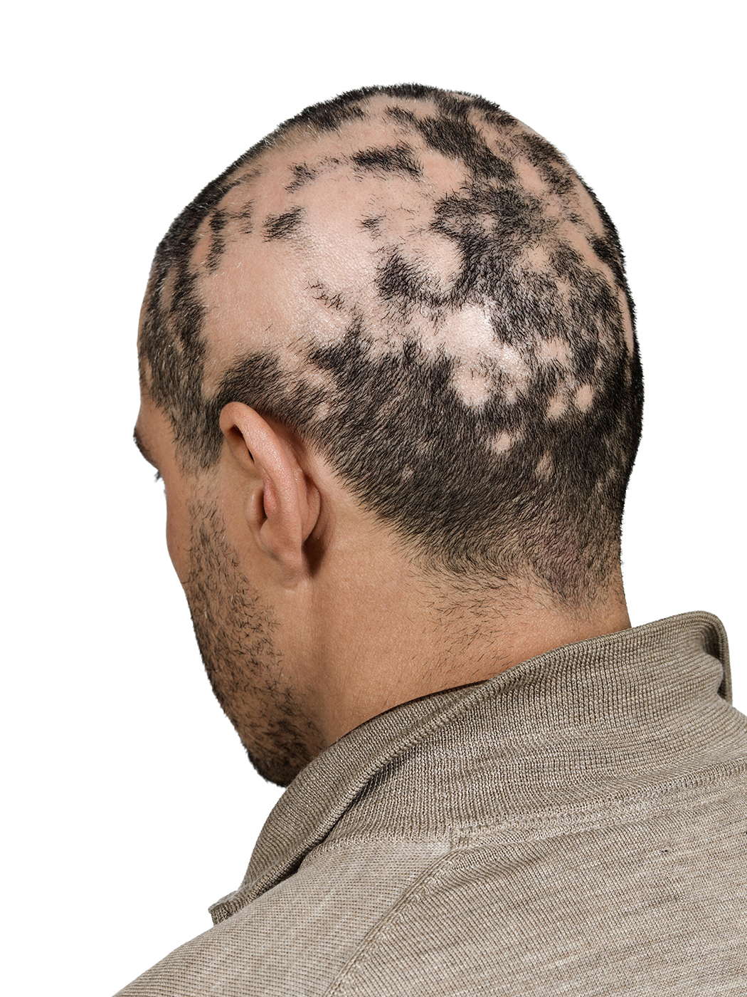 Hair Toppiks Hair Regrowth for Men and Hair Loss Options