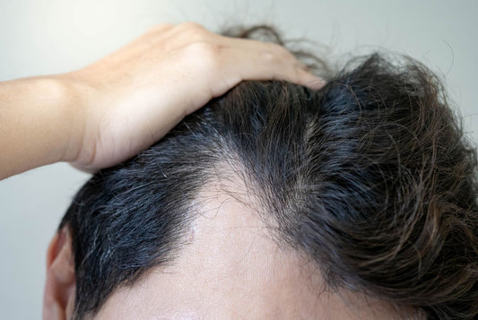 Stress and Hair Loss: Causes, Symptoms, and Solutions