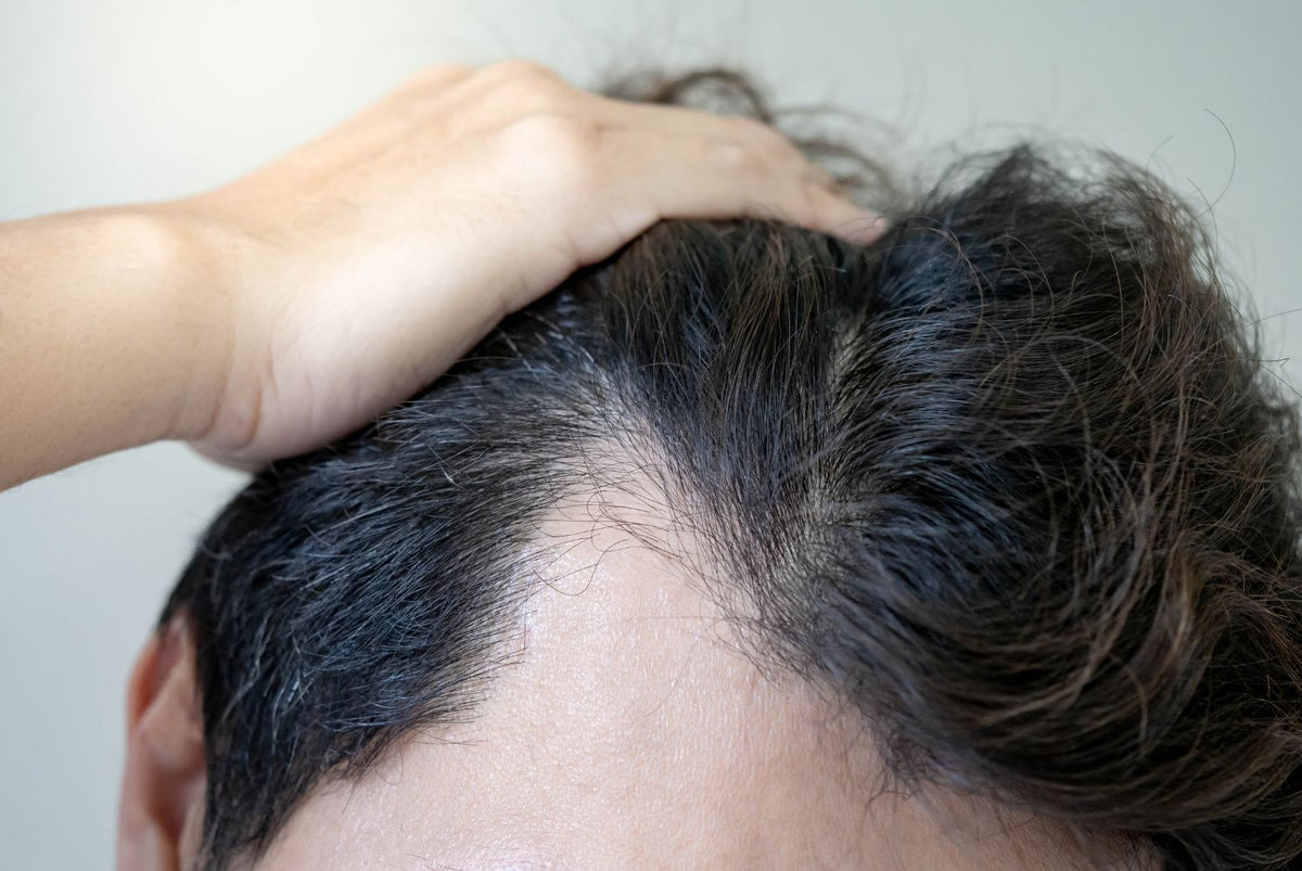 Stress and Hair Loss: Causes, Symptoms, and Solutions