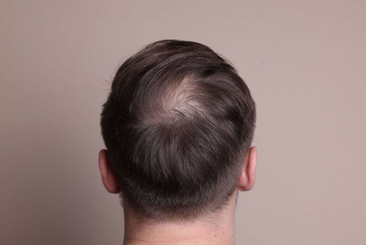 Men's Hair Loss: What You Need to Know