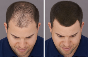 man with thinning hair before and after toppik fibers application toppik blog