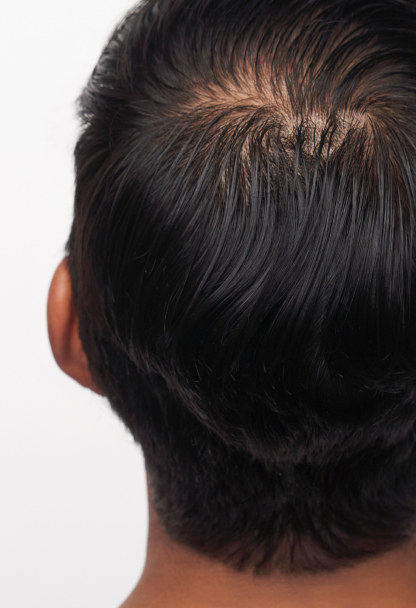 THINNING SPOTS