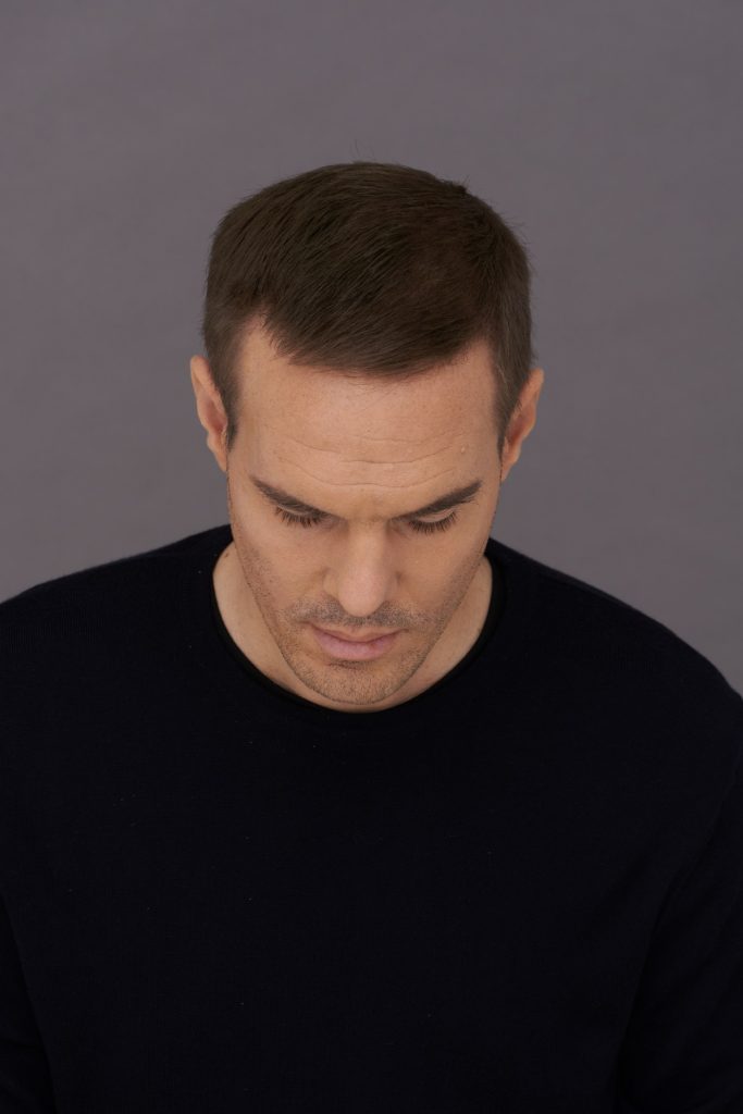 man Steve real user after Toppik hair fibers using toppik hair fibers to fix a receding hairline toppik hair blog