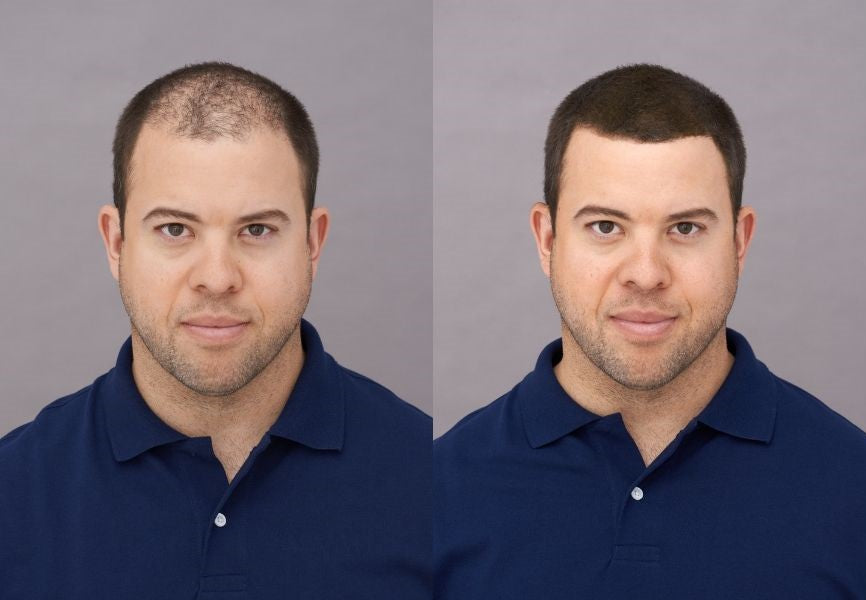 before after results photo real user man Adam Toppik Hair Building Fibers mens grooming tips for thin hair toppik hair blog