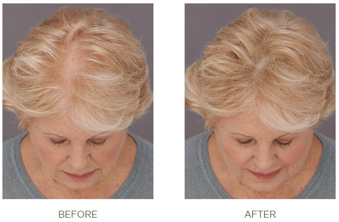 Top view of a blonde woman’s head before and after using Toppik Hair Fibers, showing visibly fuller-looking hair.