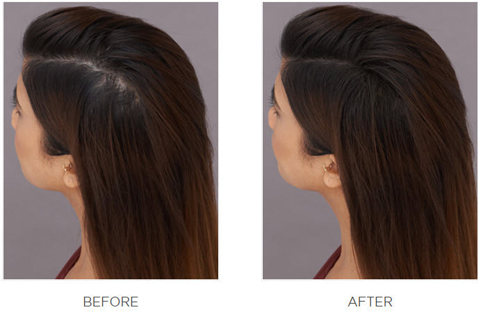 before and after image of a woman's head crown looking visibly thicker after applying Toppik Hair Fiber