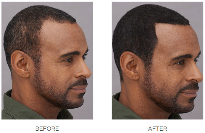 side view of a man’s head before and after using Toppik Hair Fibers, showing visibly fuller-looking hairline.