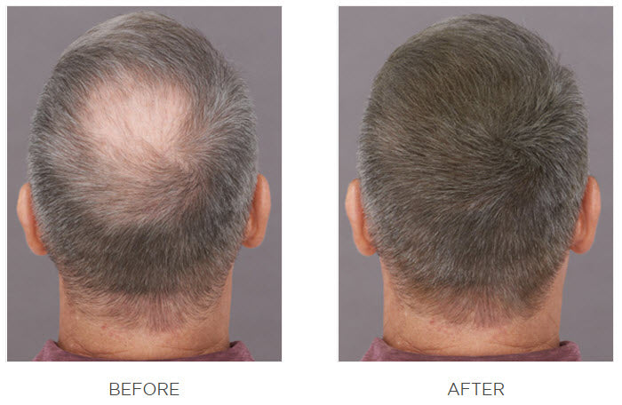 Back top view of a man’s head before and after using Toppik Hair Fibers, showing visibly fuller-looking hair.