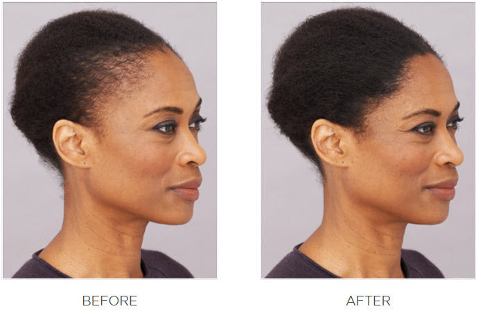 Side view of a woman’s head before and after using Toppik Hair Fibers, showing visibly fuller-looking hair.