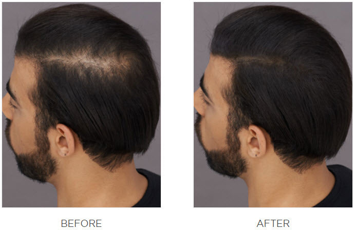 Top side view of a man’s head before and after using Toppik Hair Fibers, showing visibly fuller-looking hair.