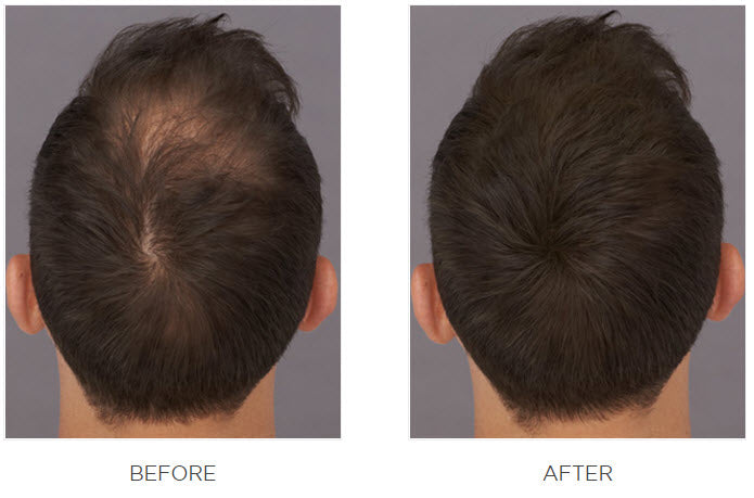 Top view of a man’s head before and after using Toppik Hair Fibers, showing visibly fuller-looking hair.
