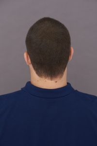 Back of head bald spot after toppik hair fibers application toppik hair blog