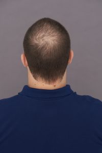 Back of head bald spot before toppik hair fibers application toppik hair blog