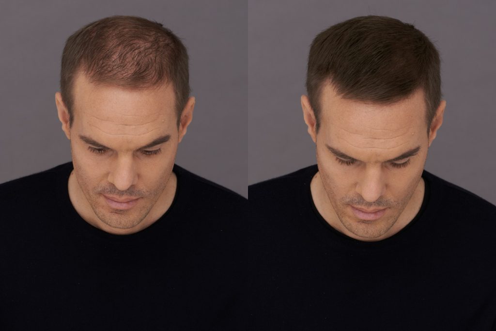 Before and After photos male user Steve Toppik Fibers results